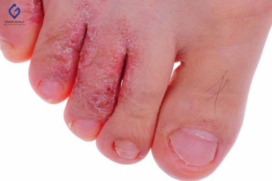Nấm Da Chân: Nguyên Nhân, Dấu Hiệu và Phòng Ngừa Hiệu Quả