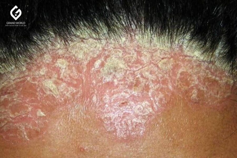 VẢY NẾN DA ĐẦU VÀ CÁCH KIỂM SOÁT HIỆU QUẢ
