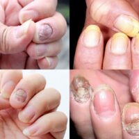 Vảy Nến Móng Tay: Nhận Diện & Kiểm Soát Từ Sớm