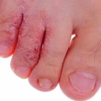Nấm Da Chân: Nguyên Nhân, Dấu Hiệu và Phòng Ngừa Hiệu Quả