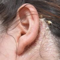 NẤM DA ĐẦU VÀ NHỮNG THÔNG TIN CẦN BIẾT!