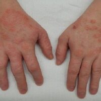 Viêm Da Cơ Địa Là Gì?