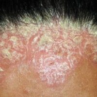 VẢY NẾN DA ĐẦU VÀ CÁCH KIỂM SOÁT HIỆU QUẢ