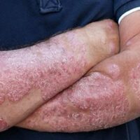 Bệnh vảy nến là gì? Những thông tin bạn cần biết